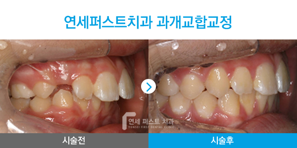 부천 상동 부분교정