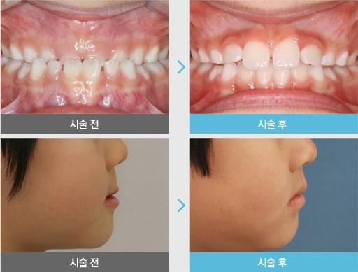 부천부정교합