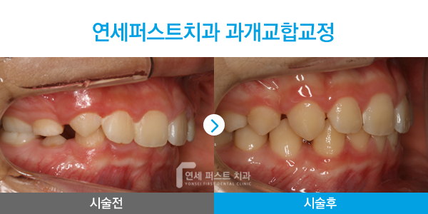 부천 상동 부분교정