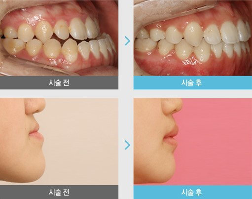 부천부정교합