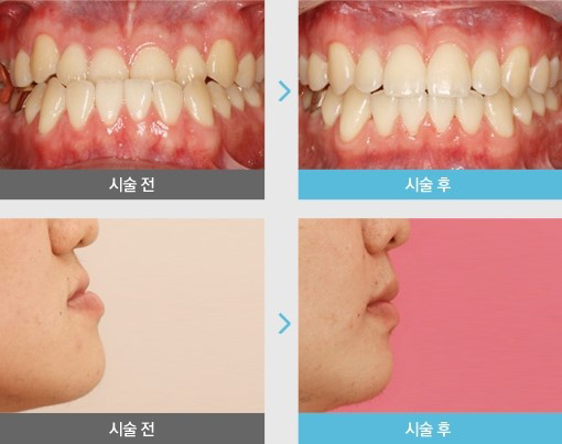 부천부정교합