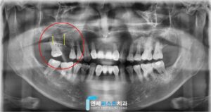 부천 상악동거상술 임플란트 뼈이식 과정