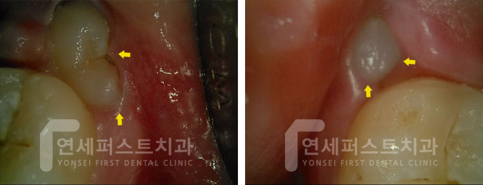 부천 매복사랑니