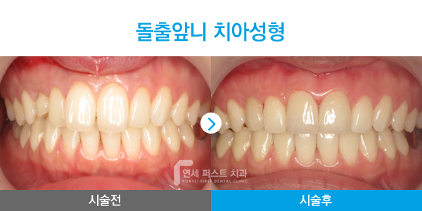 부천 라미네이트
