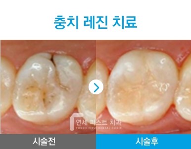부천 레진치료