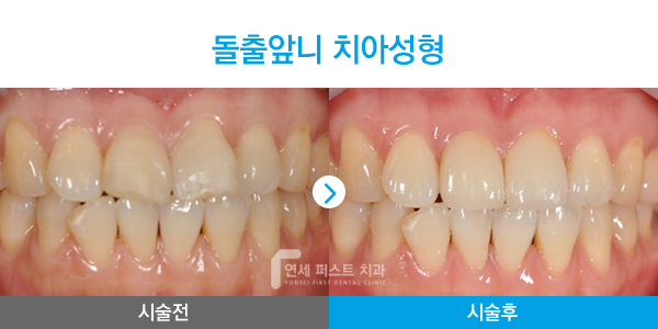 부천 라미네이트
