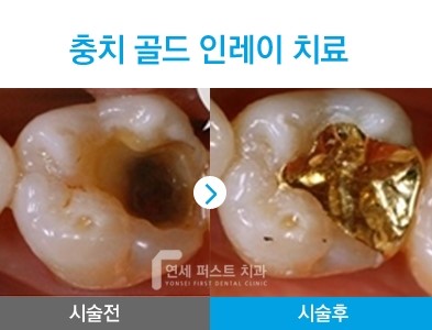 부천 레진치료