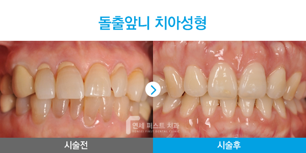 부천 라미네이트