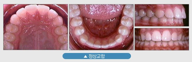 Read more about the article 부천부정교합, 3급 부정교합(반대교합) 교정 전후