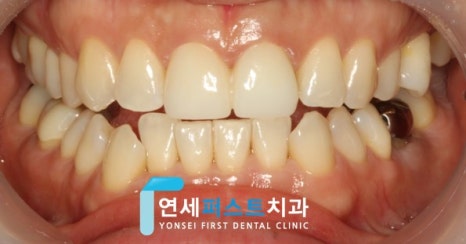 Read more about the article 부천실활치미백, 신경치료 후 변색된 앞니 어떻게 관리할까요