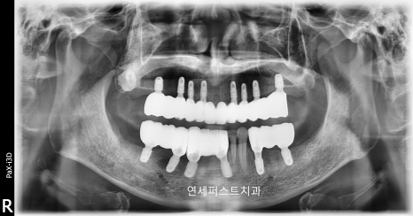 Read more about the article 부천전체임플란트, 전체 임플란트 과정과 변화 사례 정리