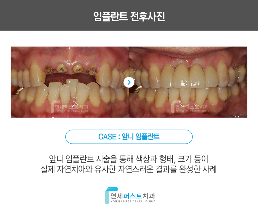 Read more about the article 부천깨진치아, 앞니 깨졌을 때 대처 방법과 복원 과정 정리