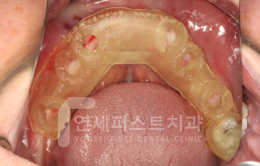 Read more about the article 상동역임플란트, 당뇨가 있어도 가능할까요? 꼭 확인해야 할 사항