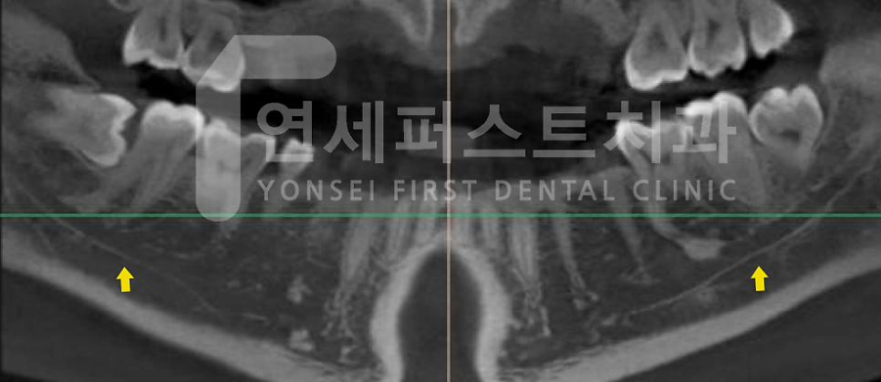 Read more about the article 상동역매복사랑니, 통증이 없어도 확인이 필요한 이유