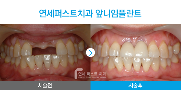 Read more about the article 부천앞니임플란트, 심미성과 기능까지 고려해야 하는 이유